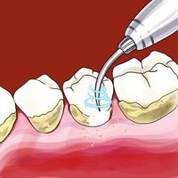 Готовая статья Зубная чистка ультразвуком